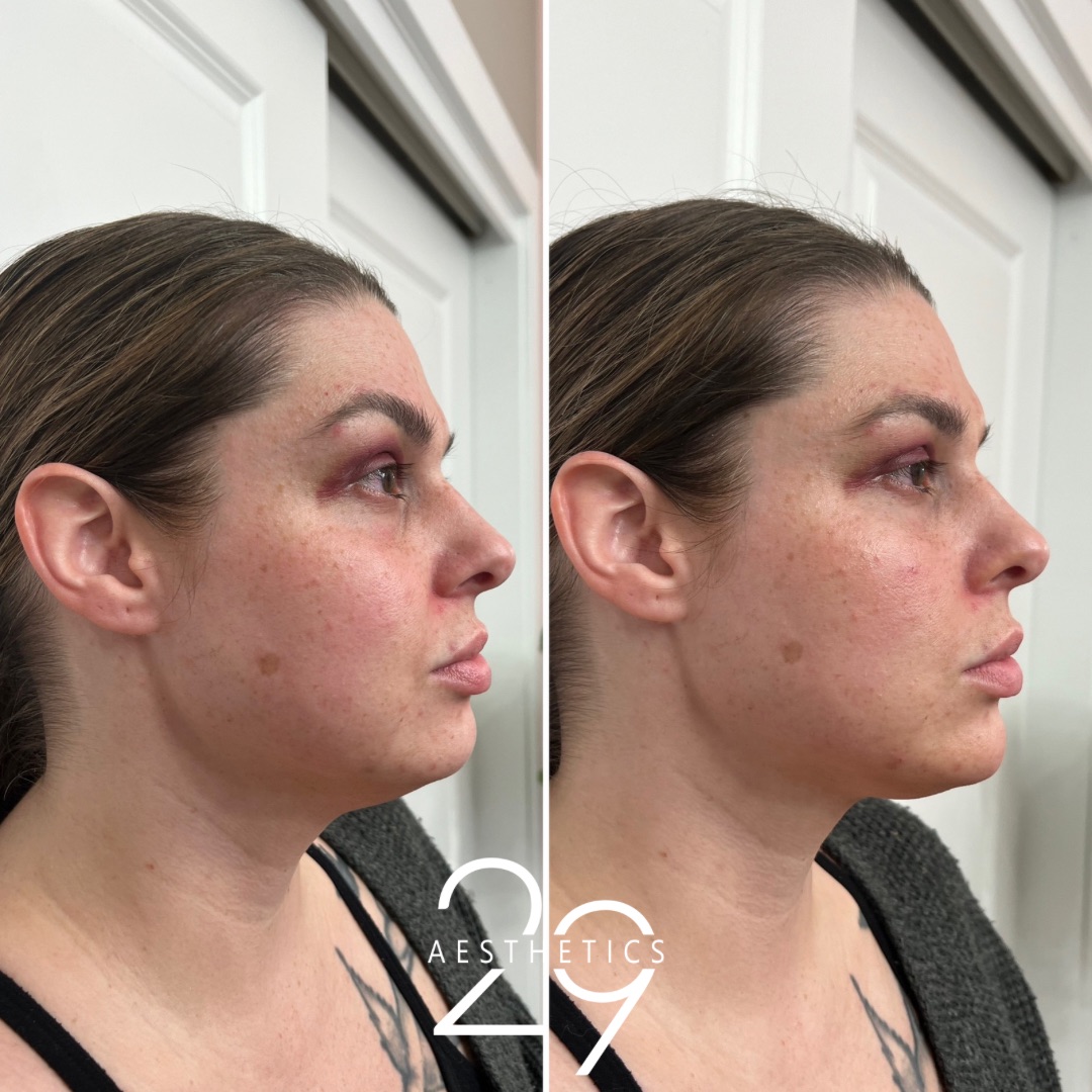 Chin filler before and after comparison photo of woman.