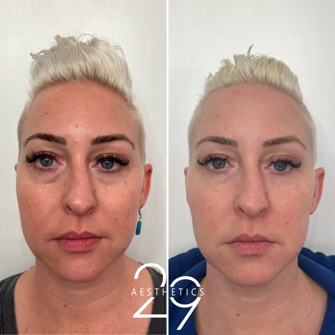 Before and after images of woman who has received undereye filler treatment at 29 Aesthetics.
