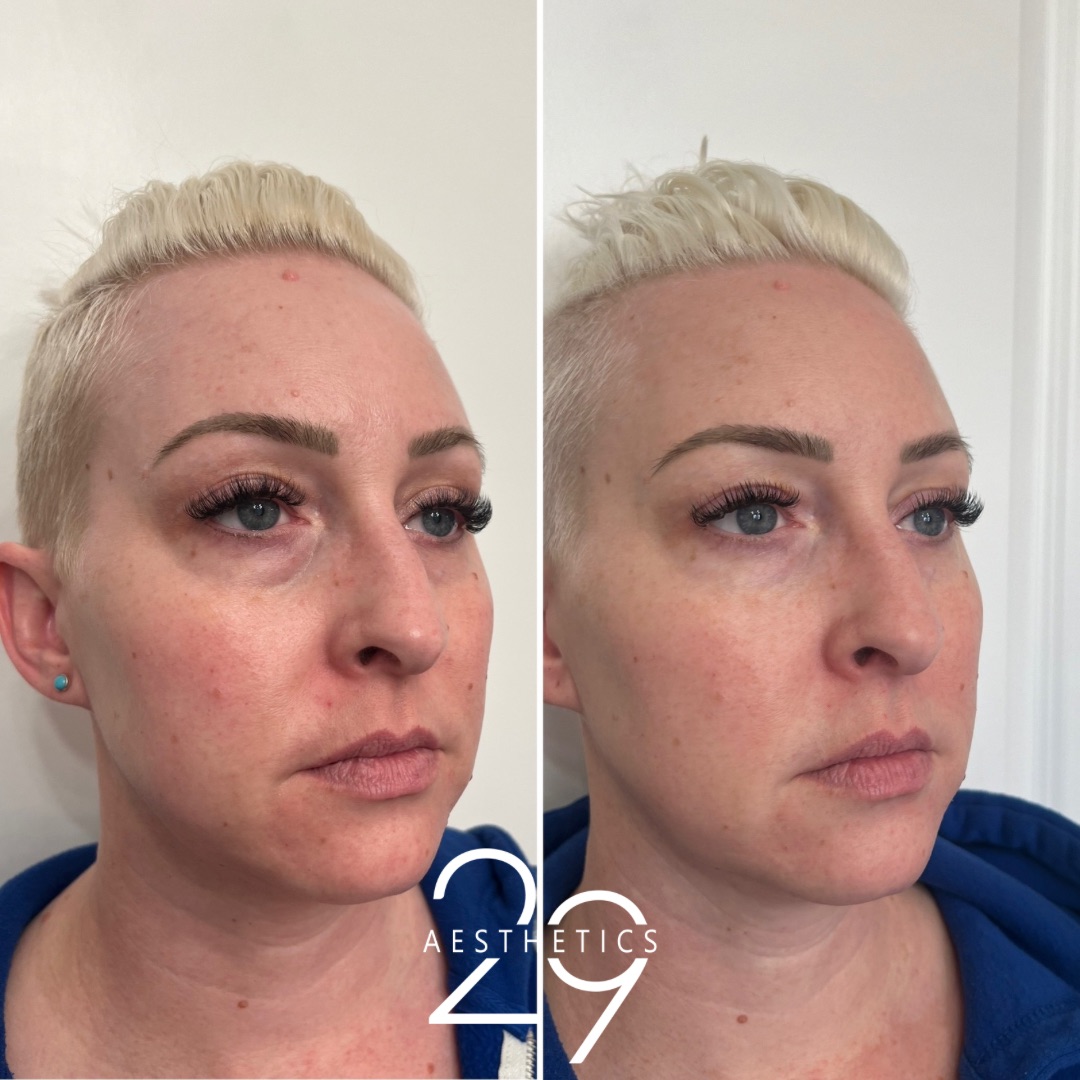 Before and after images of woman who has received undereye filler treatment at 29 Aesthetics.
