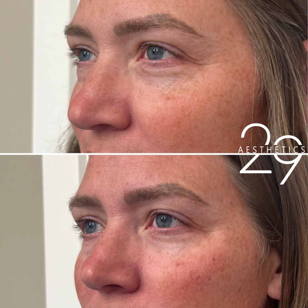 Before and after images of woman who has received undereye filler treatment at 29 Aesthetics.