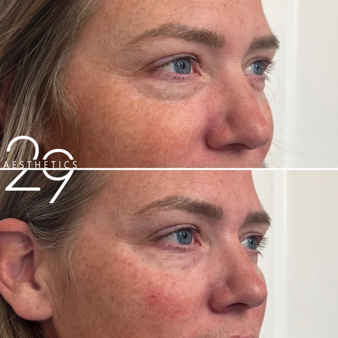 Before and after images of woman who has received undereye filler treatment at 29 Aesthetics.