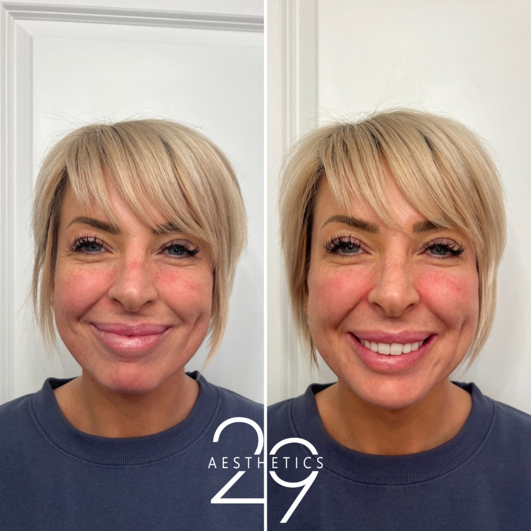 before and after using Sculptra