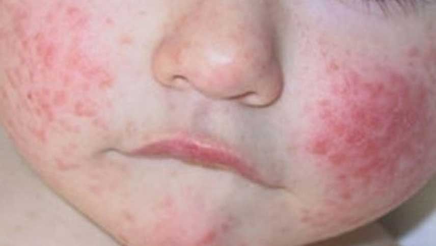 dermatitis atópica en niños