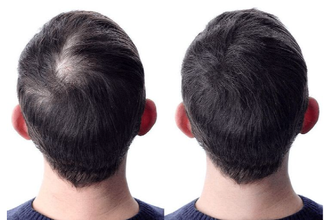 HAIR TRANSPLANTATION