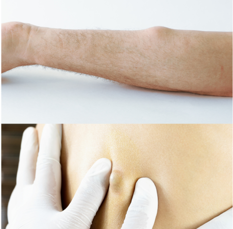 LIPOMA AND SEBACEOUS CYST SURGERY