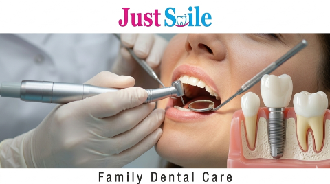 DENTAL IMPLANT FIXING