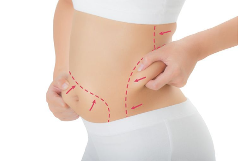 LIPOSUCTION / ABDOMINOPLASTY