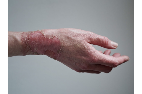 BURNS/BURNS CONTRACTURES
