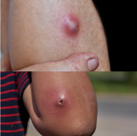 ABSCESS DRAINAGE