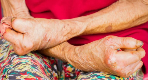LEPROSY