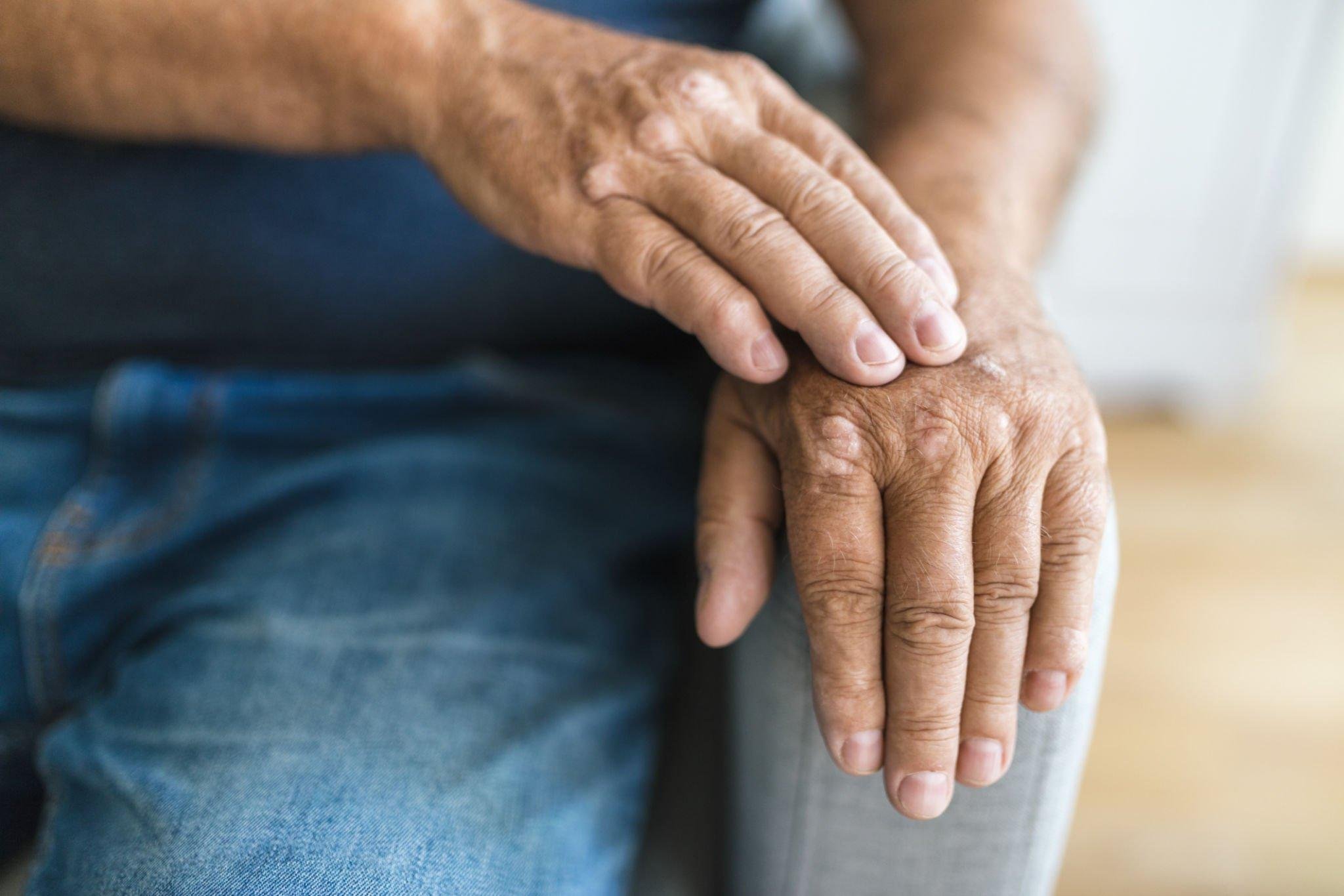 Exploring Psoriatic Arthritis Treatments: What to Know Now