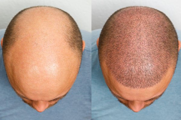 Natural Hair Transplant Prices in the UK: What to Expect