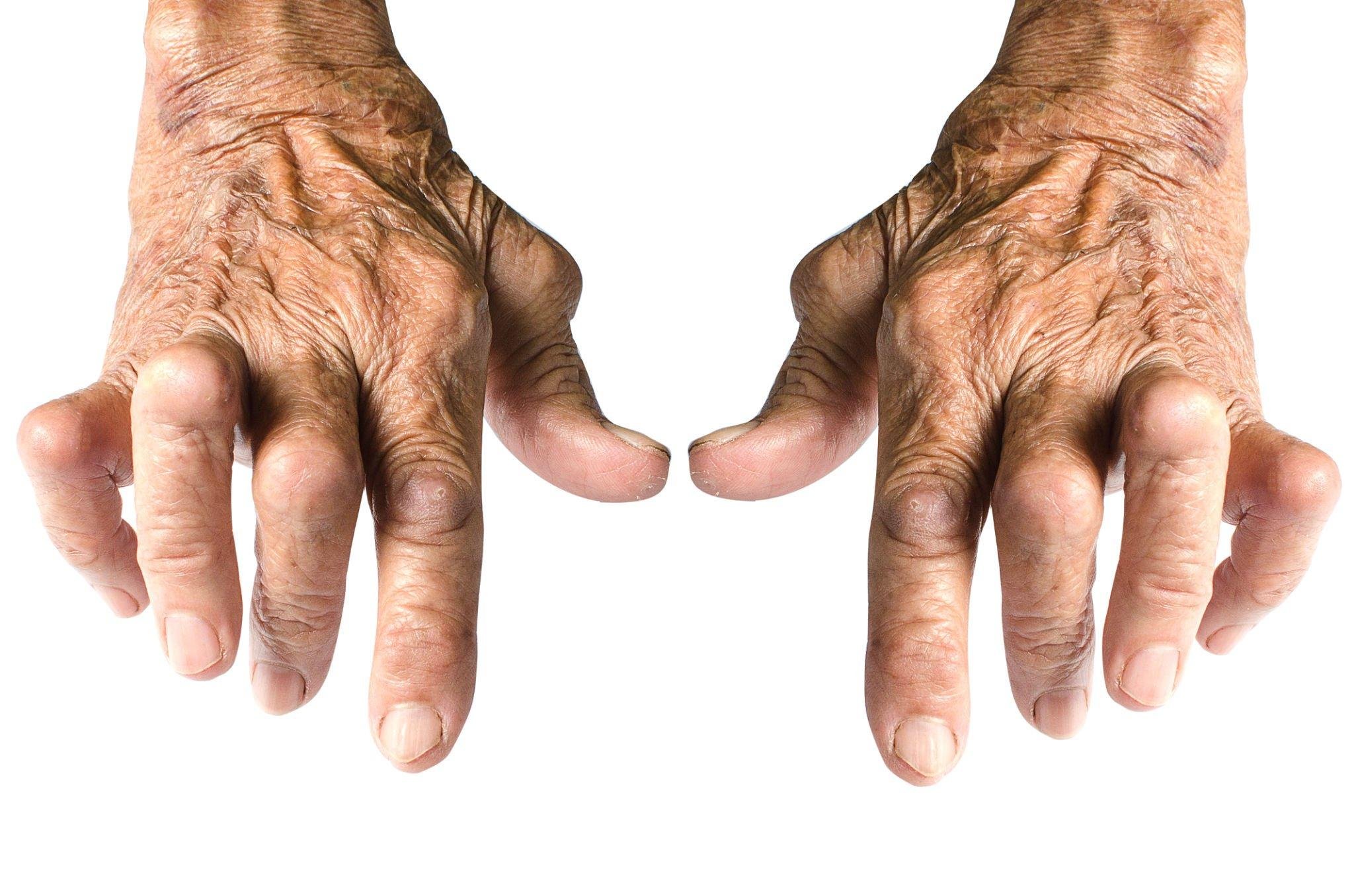 Affordable Arthritis Treatment