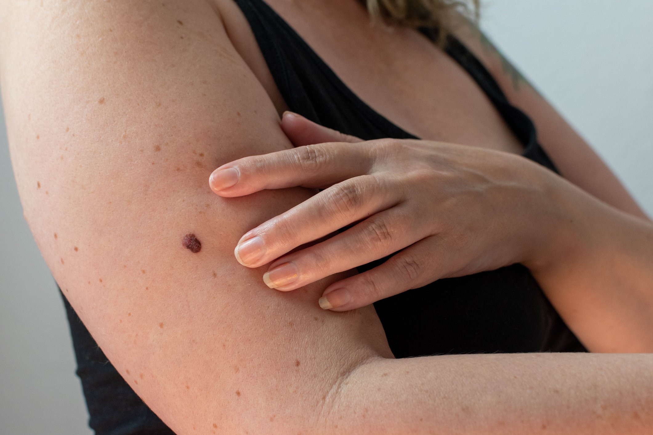What Mycosis Fungoides Rash Looks Like