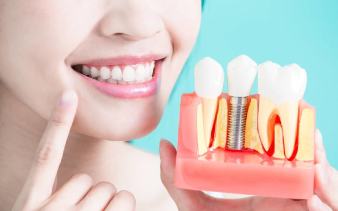 Dental Implants in Austria: A Trusted Solution for a Confident Smile
