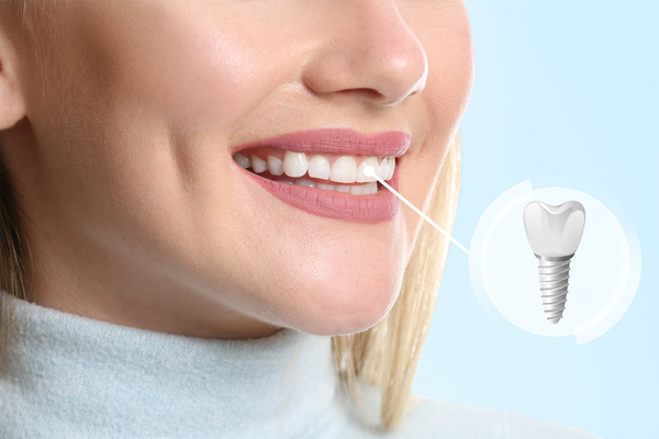 Guide To Being Eligible For Immediate Dental Implant Surgery