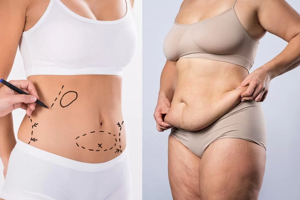 Understanding Tummy Tuck Clinical Trials
