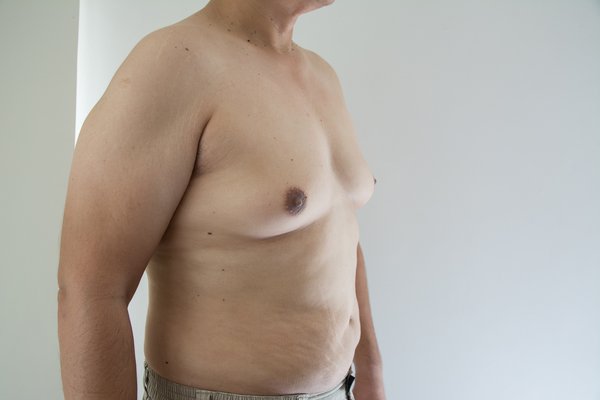 How to Participate in Gynecomastia Clinical Trials