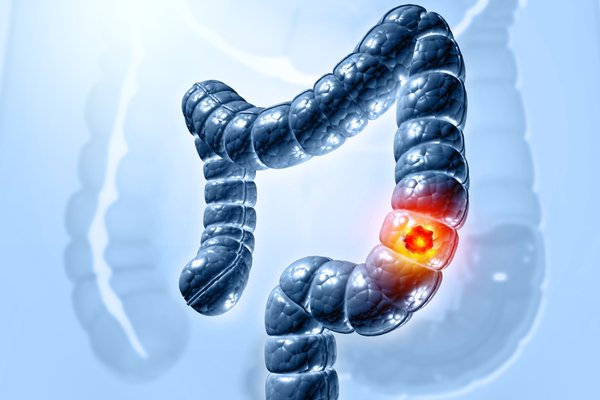 Early Signs Of Colon Cancer In Young Women