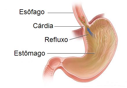 Dicas para evitar o refluxo gástrico