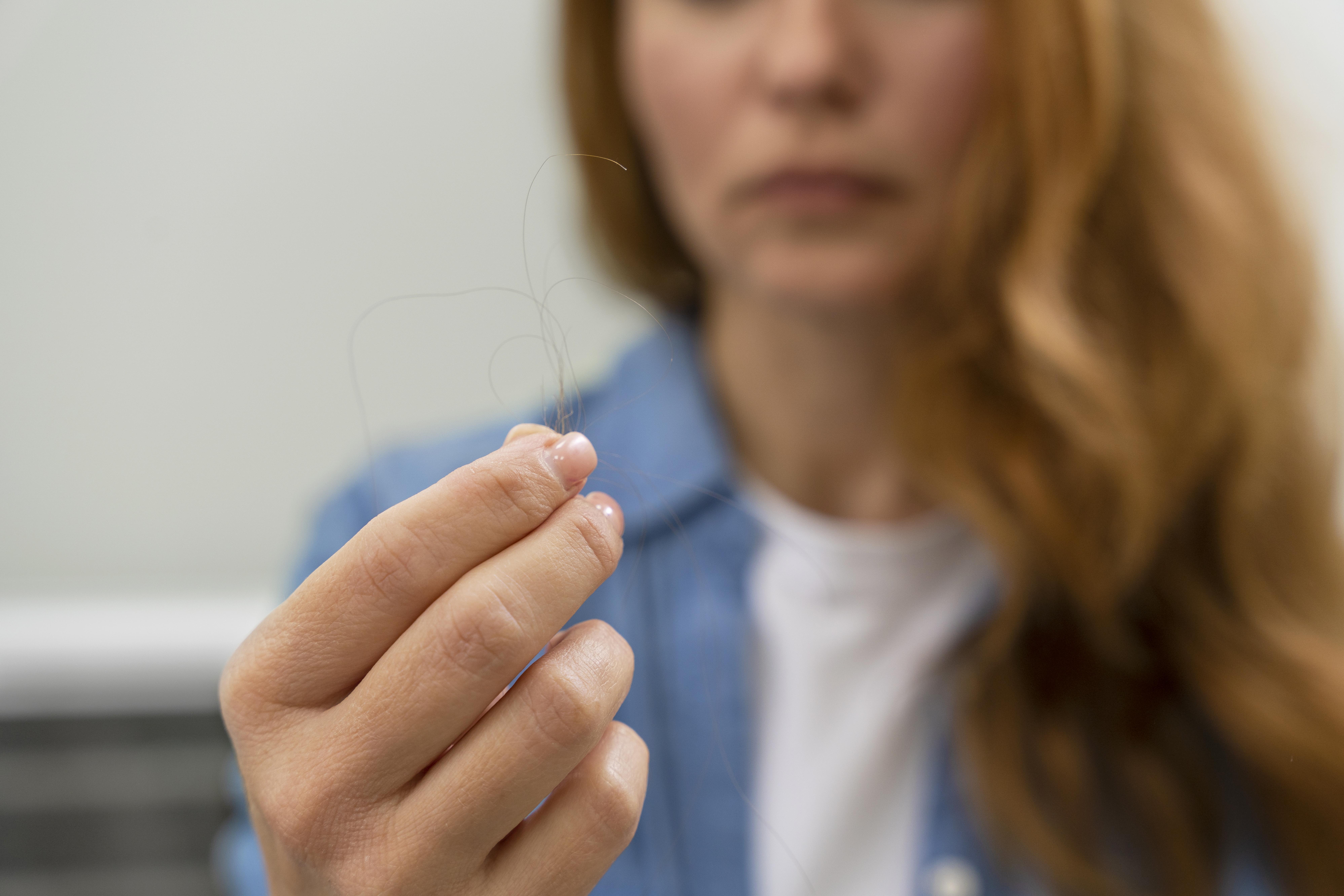 GLP-1 weight loss drugs show 37% to 68% greater hair loss risk
