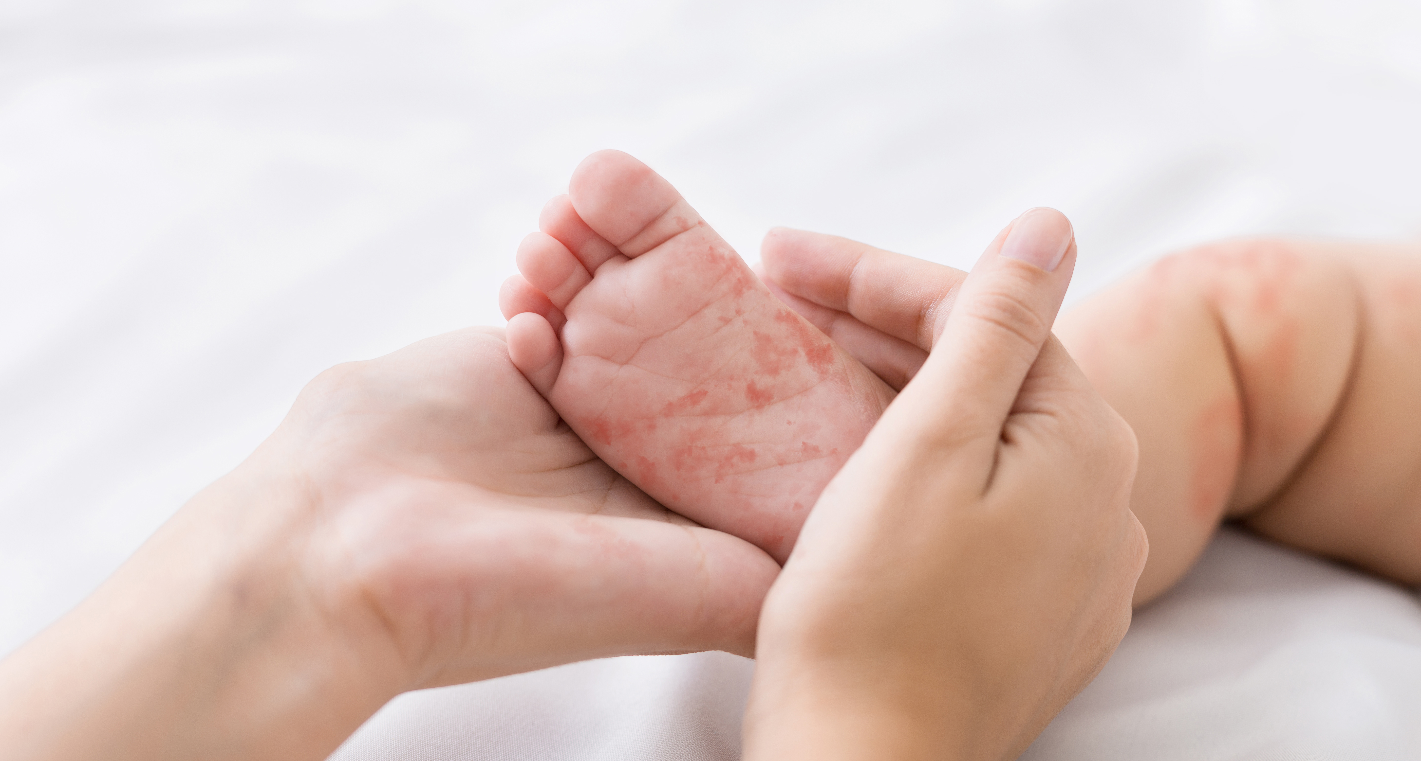 Kent sees 9 new measles cases; health chiefs urge MMR jabs