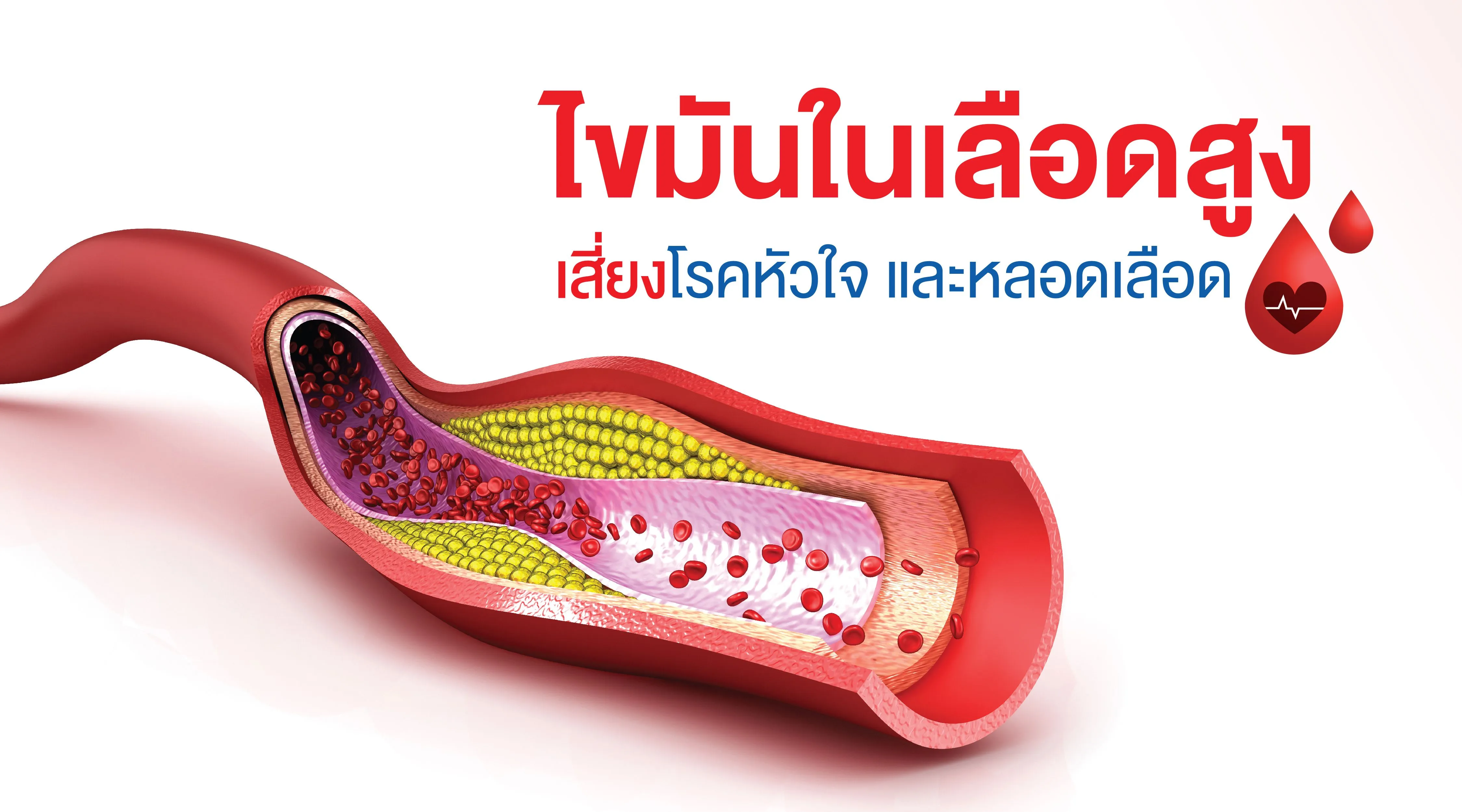 6.โรคไขมันในเลือดสูง.webp