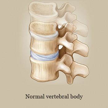 Compression Fracture and Kyphoplasty Illustration