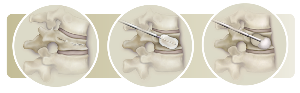 Balloon Kyphoplasty Illustration