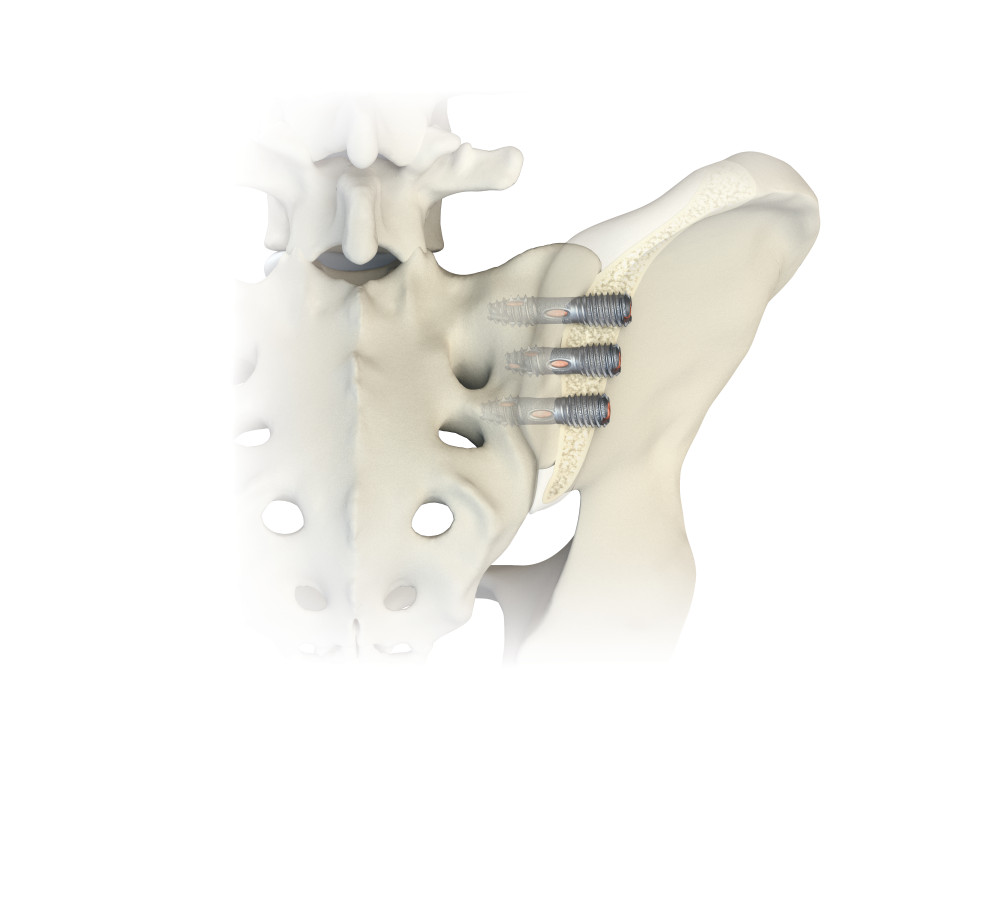 Minimally Invasive Sacroiliac Joint Outlet View