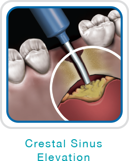 <p>Crestal sinus elevation</p>