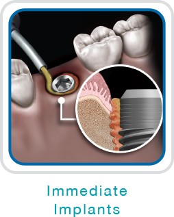 <p>Immediate implants</p>