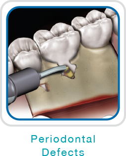 <p>Periodontal defects</p>