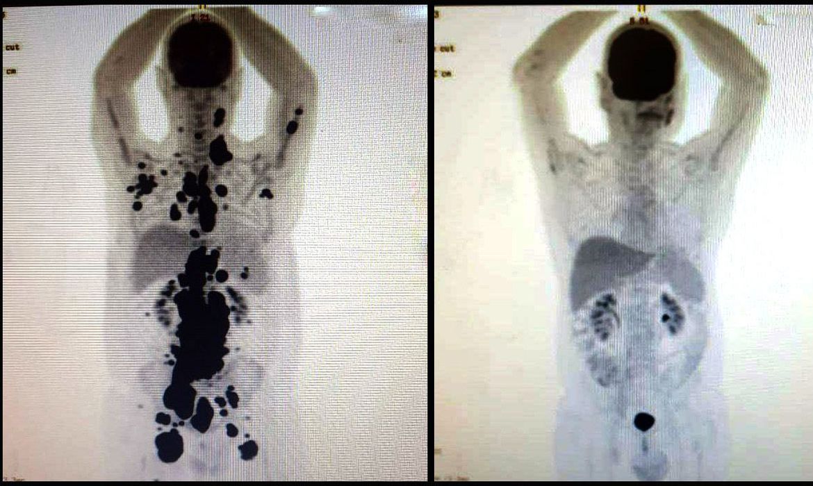 Notícias da ciência: com a terapia CAR-T Cell, o paciente teve remissão completa de um linfoma em apenas um mês