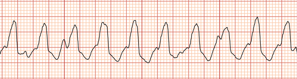 Ventricular tachycardia - Cancer Therapy Advisor