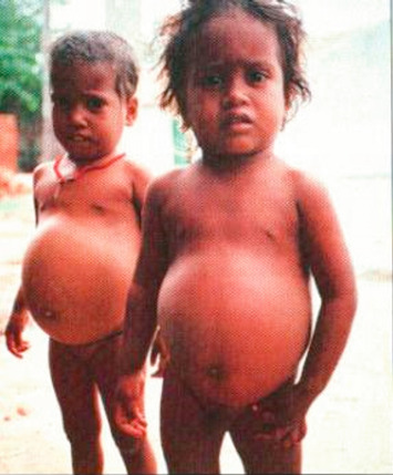 Kwashiorkor - an overview | ScienceDirect Topics