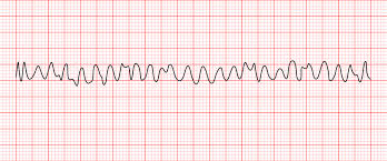 Ventricular Fibrillation: Causes & Treatment [ACLS Algorithm]