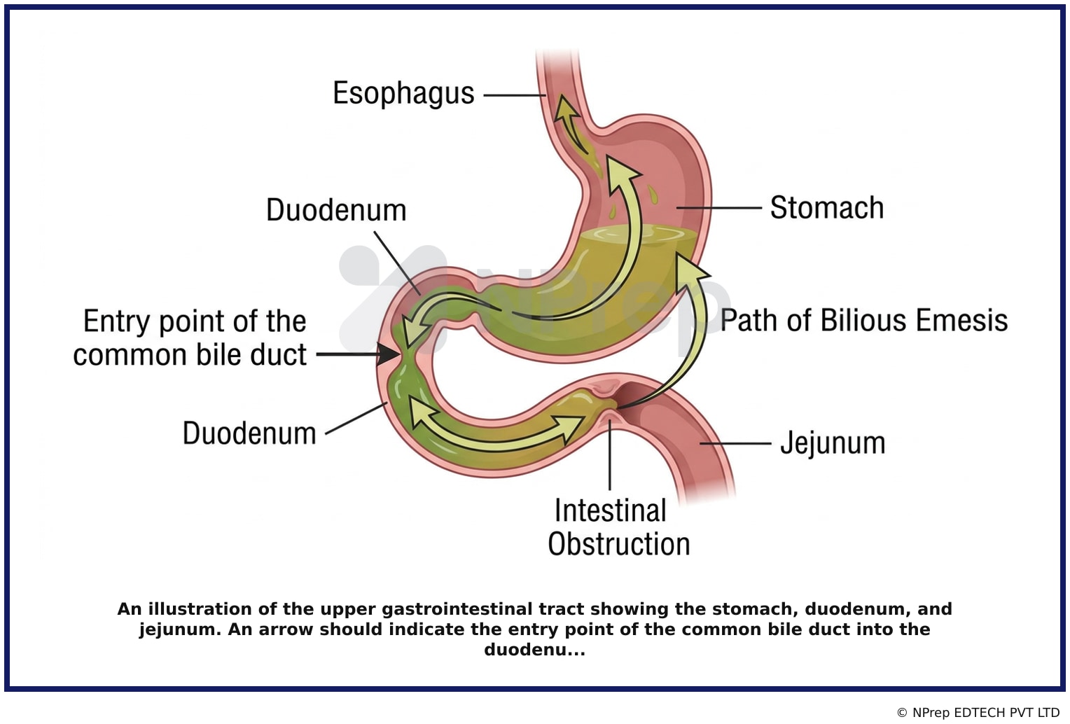 An illustration of the upper gastrointestinal tract showing the stomach, duodenum, and jejunum. An arrow should indicate the entry point of the common bile duct into the duodenu...
