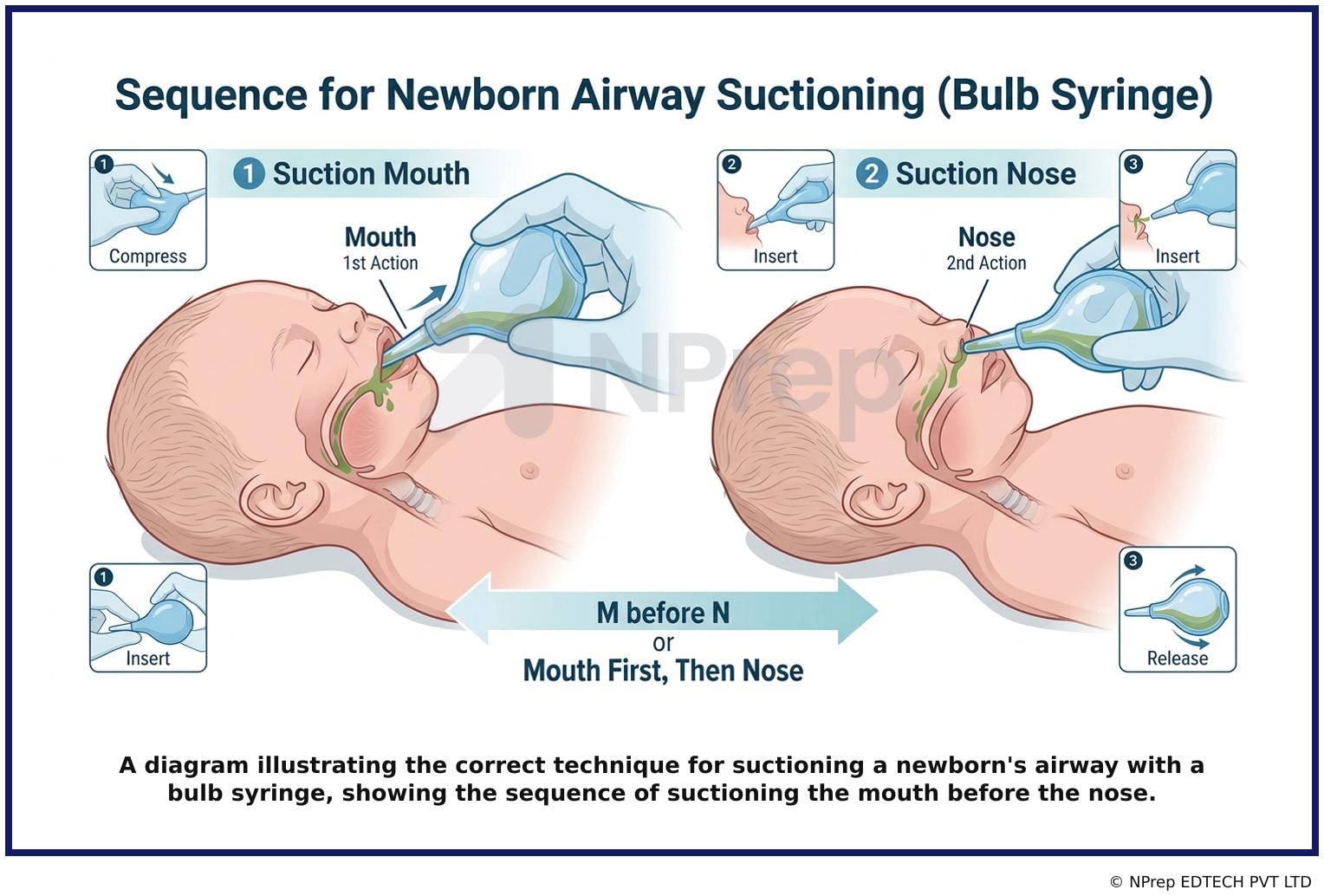 A diagram illustrating the correct technique for suctioning a newborns airway with a bulb syringe, showing the sequence of suctioning the mouth before the nose.