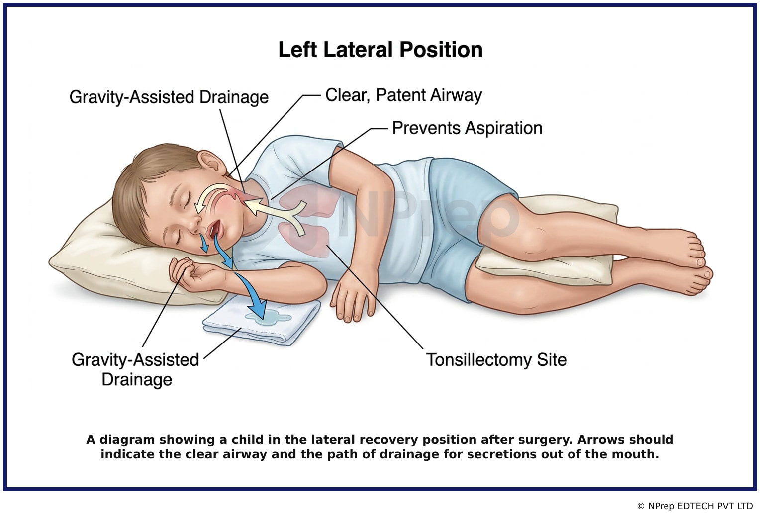 A diagram showing a child in the lateral recovery position after surgery. Arrows should indicate the clear airway and the path of drainage for secretions out of the mouth.