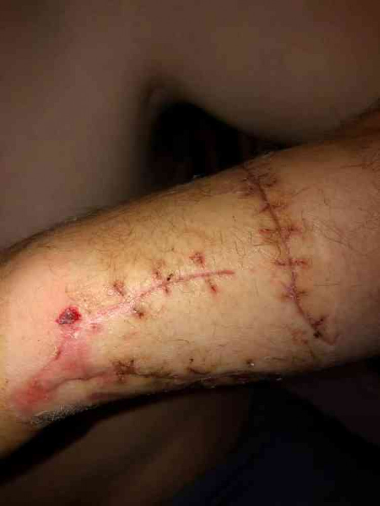 The victim's arm after surgery