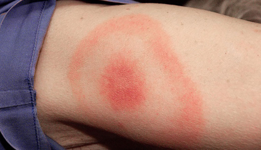 Early symptoms of Lyme disease include a ‘bullseye’ rash around the site of the tick bite