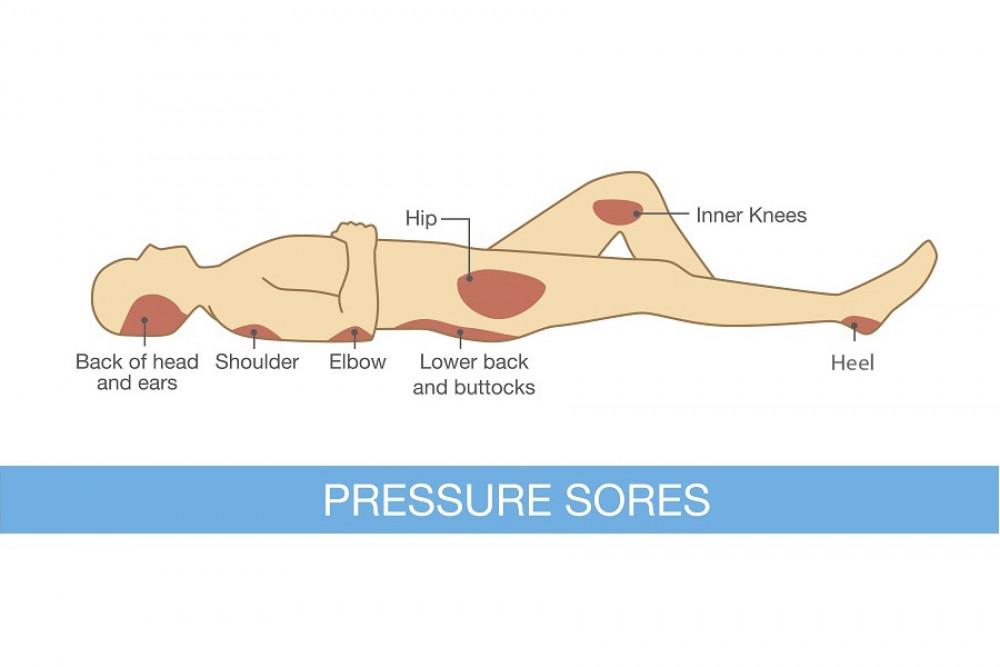 Where pressure sores might occur. 