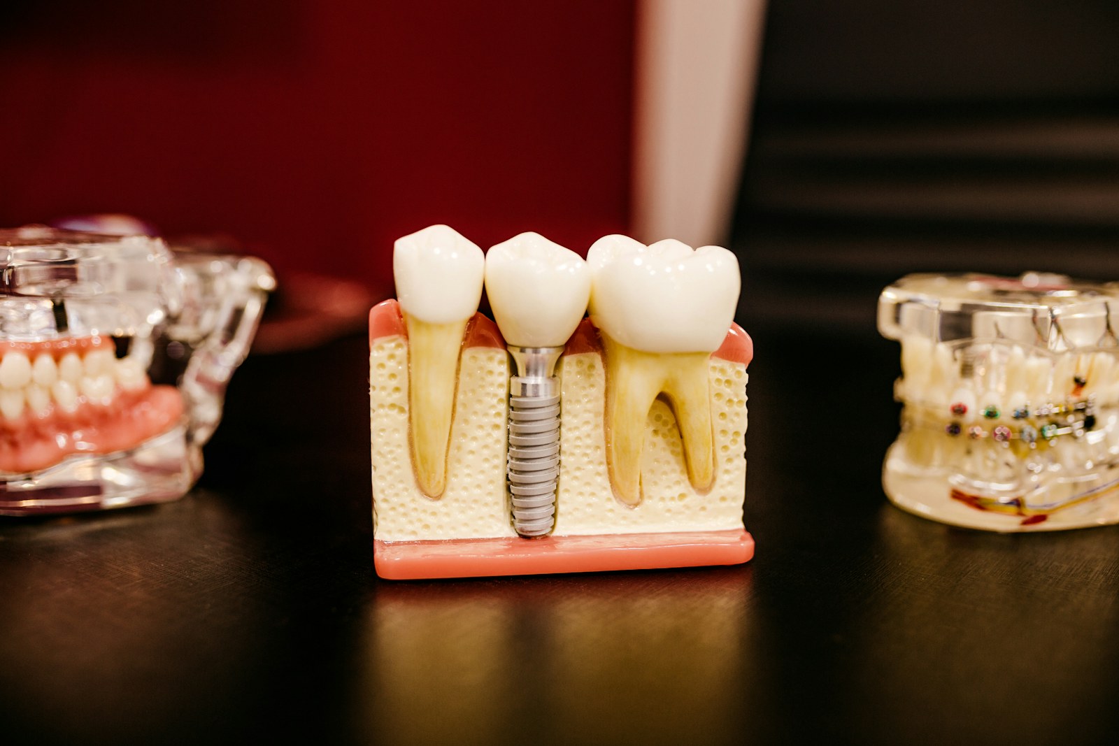 Dental Implants: The Complete Guide to Replacing Missing Teeth
