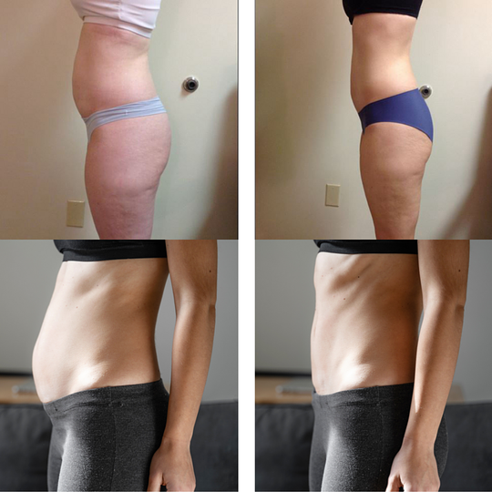 3 Cavi Lipo