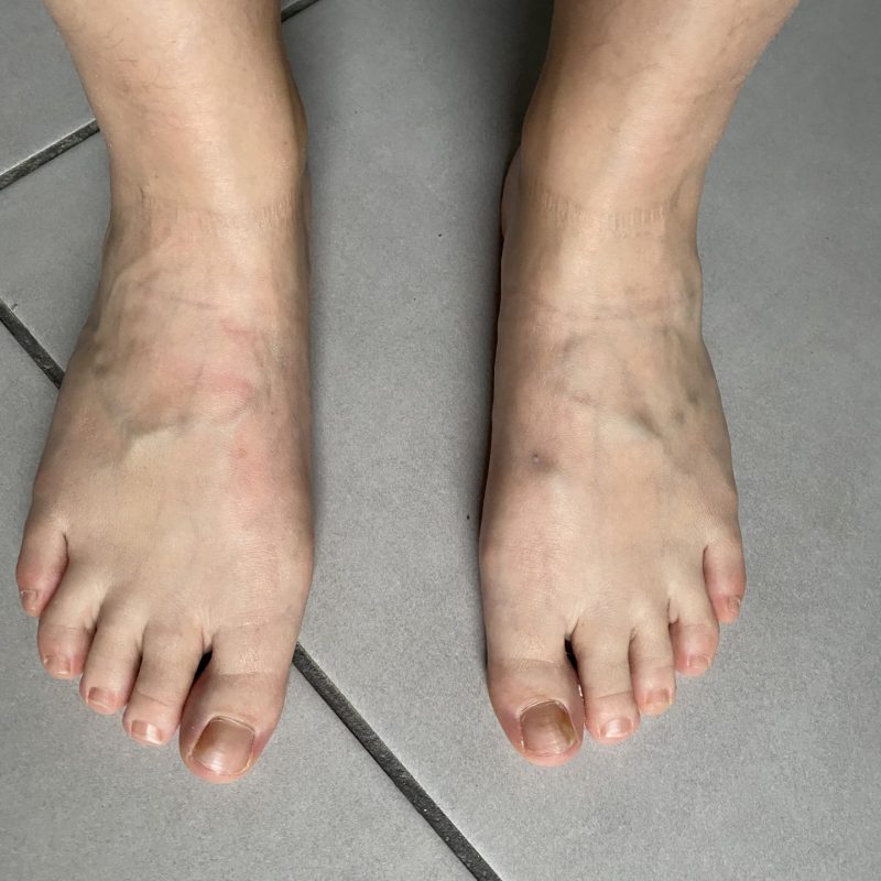Pied après séance de sport