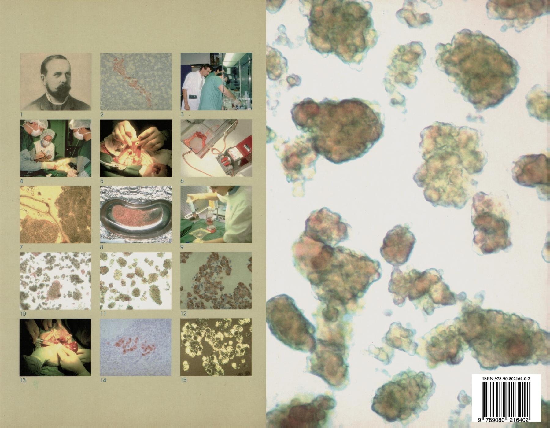 Achterkant van Pancreatic islet transplantation