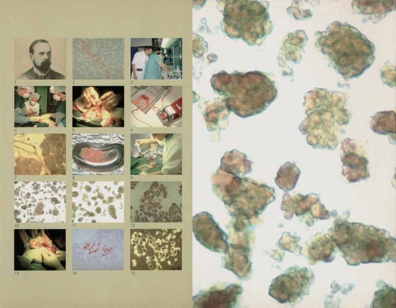 Achterkant van Pancreatic islet transplantation