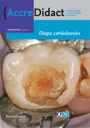 Omslag van Diepe carieslaesies