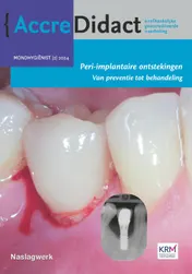 Omslag van Peri-implantaire ontstekingen